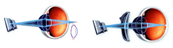 presbiopia e come curarla