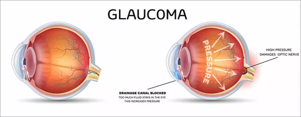 Il glaucoma spiegato semplicemente