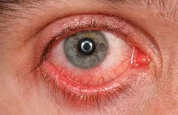 Congiuntivite: come riconoscerla e comprenderne le cause