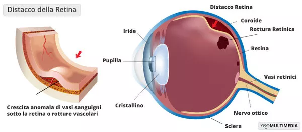 Distacco della retina: cause, sintomi e prevenzione 