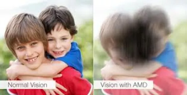 Degenerazione maculare legata all’età: conoscerla e distinguerla da altre patologie visive 