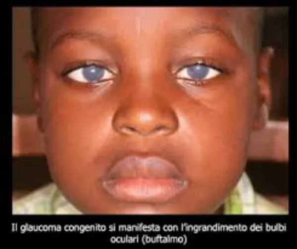 Sintomi e meccanismi di contagio del tracoma, la malattia degli occhi cagionata da batteri Sintomi e meccanismi di contagio del tracoma, la malattia degli occhi cagionata da batteri