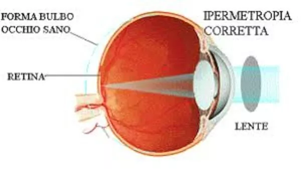 IPERMETROPIA-cosa-è IPERMETROPIA-cosa-è