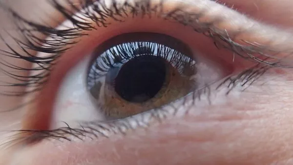 alterazione della trasparenza della cornea alterazione della trasparenza della cornea