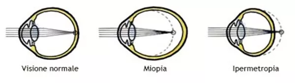 I DIFETTI OTTICI DELL' OCCHIO
